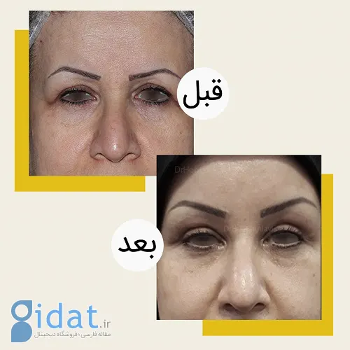 هزینه لیفت اندوسکوپی ابرو چقدر است؟